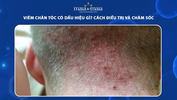 Viêm Chân Tóc: Nhận Biết Triệu Chứng, Nguyên Nhân Và Giải Pháp Tối Ưu Viêm Chân Tóc: Nhận Biết Triệu Chứng, Nguyên Nhân Và Giải Pháp Tối Ưu
