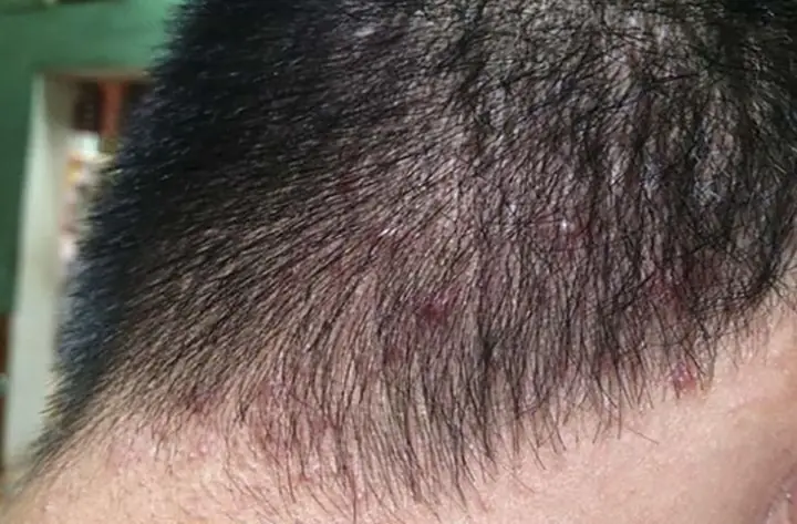 Viêm Chân Tóc: Nhận Biết Triệu Chứng, Nguyên Nhân Và Giải Pháp Tối Ưu Viêm Chân Tóc: Nhận Biết Triệu Chứng, Nguyên Nhân Và Giải Pháp Tối Ưu