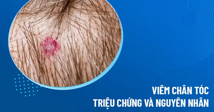 Viêm Chân Tóc: Nhận Biết Triệu Chứng, Nguyên Nhân Và Giải Pháp Tối Ưu Viêm Chân Tóc: Nhận Biết Triệu Chứng, Nguyên Nhân Và Giải Pháp Tối Ưu