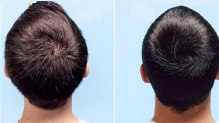 Xoáy Tóc Giữa Đỉnh Đầu: Ý Nghĩa, Vận Mệnh Và Cách Nhận Biết